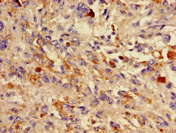 DCT / Dopachrome Tautomerase Antibody - Immunohistochemistry image of paraffin-embedded human melanoma cancer at a dilution of 1:100