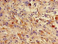 DCT / Dopachrome Tautomerase Antibody - Immunohistochemistry image of paraffin-embedded human melanoma cancer at a dilution of 1:100