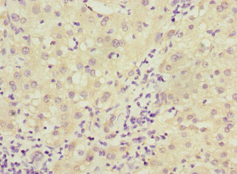 DCTD / dCMP Deaminase Antibody - Immunohistochemistry of paraffin-embedded human liver cancer at dilution 1:100