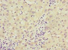 DCTD / dCMP Deaminase Antibody - Immunohistochemistry of paraffin-embedded human liver cancer at dilution 1:100