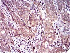 DCTN4 / Dynactin 4 Antibody - IHC of paraffin-embedded cervical cancer tissues using DCTN4 mouse monoclonal antibody with DAB staining.