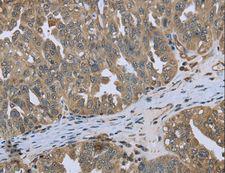 DCTN4 / Dynactin 4 Antibody - Immunohistochemistry of paraffin-embedded Human cervical cancer using DCTN4 Polyclonal Antibody at dilution of 1:50.