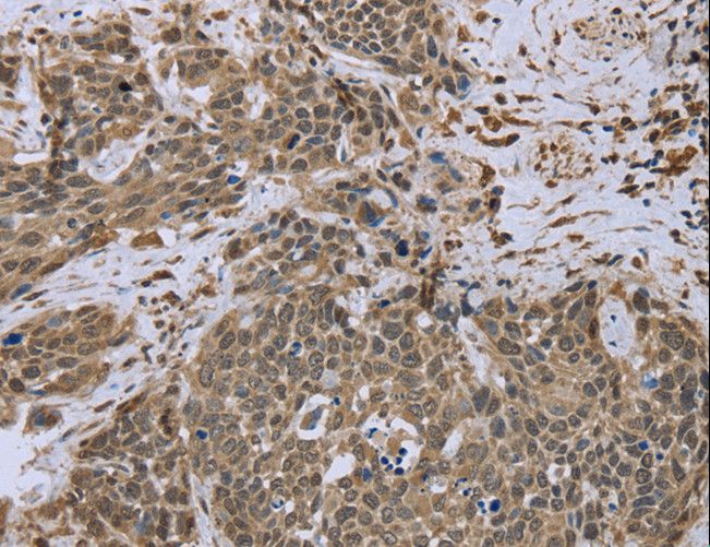 DCTN4 / Dynactin 4 Antibody - Immunohistochemistry of paraffin-embedded Human cervical cancer using DCTN4 Polyclonal Antibody at dilution of 1:50.