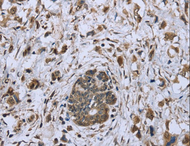 DCTN4 / Dynactin 4 Antibody - Immunohistochemistry of paraffin-embedded Human breast cancer using DCTN4 Polyclonal Antibody at dilution of 1:30.