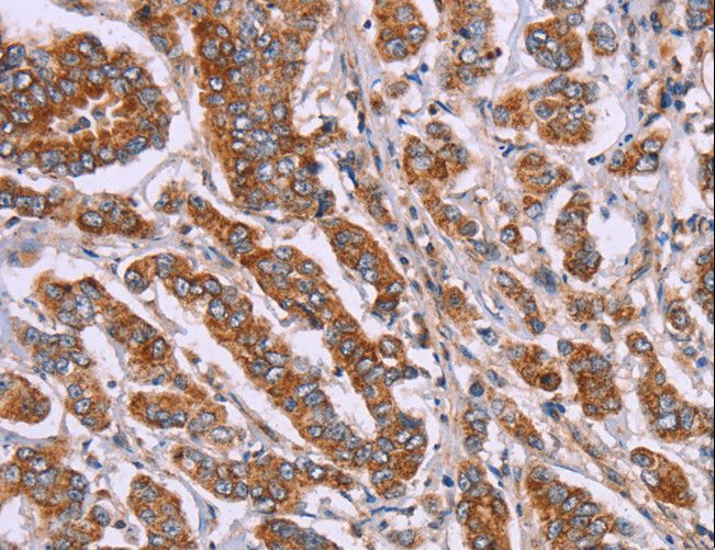 DCTN6 / Dynactin 6 Antibody - Immunohistochemistry of paraffin-embedded Human breast cancer using DCTN6 Polyclonal Antibody at dilution of 1:40.