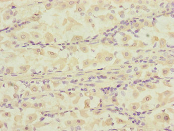 DCTN6 / Dynactin 6 Antibody - Immunohistochemistry of paraffin-embedded human gastric cancer at dilution of 1:100