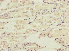 DCTN6 / Dynactin 6 Antibody - Immunohistochemistry of paraffin-embedded human gastric cancer at dilution of 1:100