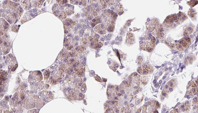 DCTN6 / Dynactin 6 Antibody - 1:100 staining human pancreas carcinoma tissue by IHC-P. The sample was formaldehyde fixed and a heat mediated antigen retrieval step in citrate buffer was performed. The sample was then blocked and incubated with the antibody for 1.5 hours at 22°C. An HRP conjugated goat anti-rabbit antibody was used as the secondary.