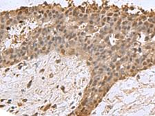 DCTPP1 / XTP3TPA Antibody - Immunohistochemistry of paraffin-embedded Human breast cancer tissue  using DCTPP1 Polyclonal Antibody at dilution of 1:85(×200)
