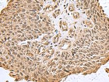 DCTPP1 / XTP3TPA Antibody - Immunohistochemistry of paraffin-embedded Human lung cancer tissue  using DCTPP1 Polyclonal Antibody at dilution of 1:80(×200)