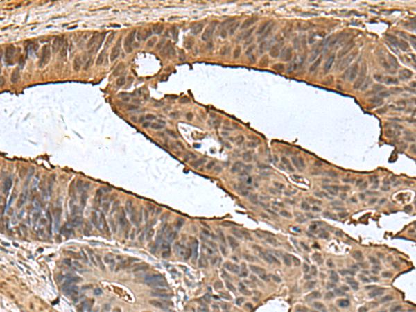 DCTPP1 / XTP3TPA Antibody - Immunohistochemistry of paraffin-embedded Human colorectal cancer tissue  using DCTPP1 Polyclonal Antibody at dilution of 1:80(×200)