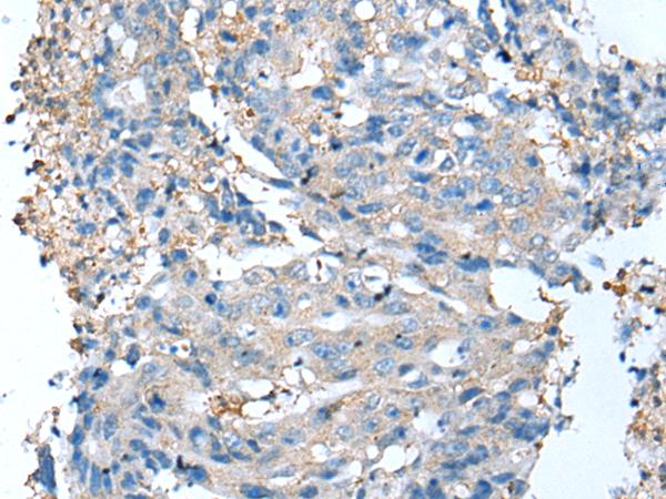 DCX / Doublecortin Antibody - Immunohistochemistry of paraffin-embedded Human colorectal cancer tissue  using DCX Polyclonal Antibody at dilution of 1:35(×200)