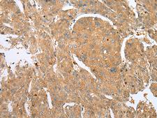 DCX / Doublecortin Antibody - Immunohistochemistry of paraffin-embedded Human liver cancer tissue  using DCX Polyclonal Antibody at dilution of 1:30(×200)