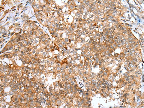 DCX / Doublecortin Antibody - Immunohistochemistry of paraffin-embedded Human esophagus cancer tissue  using DCX Polyclonal Antibody at dilution of 1:30(×200)
