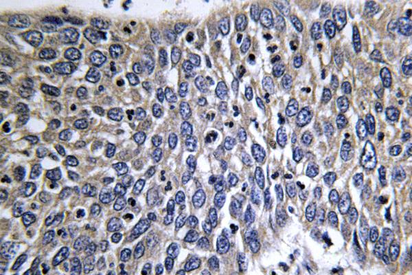 DCX / Doublecortin Antibody - IHC of Doublecortin (K292) pAb in paraffin-embedded human lung carcinoma tissue.