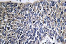 DCX / Doublecortin Antibody - IHC of Doublecortin (K292) pAb in paraffin-embedded human lung carcinoma tissue.