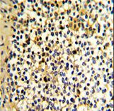 DCXR Antibody - Formalin-fixed and paraffin-embedded human kidney carcinoma with DCXR Antibody , which was peroxidase-conjugated to the secondary antibody, followed by DAB staining. This data demonstrates the use of this antibody for immunohistochemistry; clinical relevance has not been evaluated.