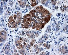 DCXR Antibody - IHC of paraffin-embedded Carcinoma of liver tissue using anti-DCXR mouse monoclonal antibody. (Dilution 1:50).