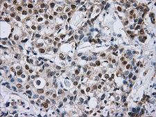 DCXR Antibody - IHC of paraffin-embedded Adenocarcinoma of breast tissue using anti-DCXR mouse monoclonal antibody. (Dilution 1:50).
