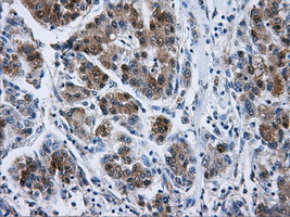DCXR Antibody - IHC of paraffin-embedded Carcinoma of liver tissue using anti-DCXR mouse monoclonal antibody. (Dilution 1:50).
