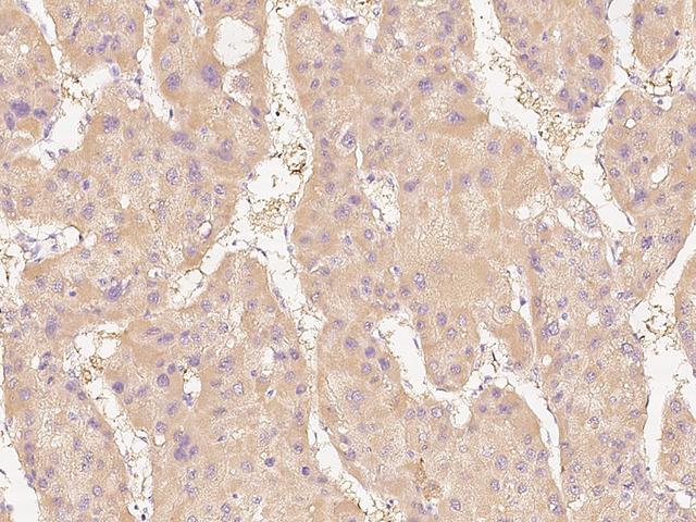 DDAH1 Antibody - Immunochemical staining of human DDAH1 in human hepatoma with rabbit polyclonal antibody at 1:300 dilution, formalin-fixed paraffin embedded sections.