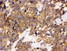DDAH2 Antibody - IHC testing of FFPE human lung cancer tissue with DDAH2 antibody at 1ug/ml. HIER: steam in pH6 citrate buffer and allow to cool prior to staining.
