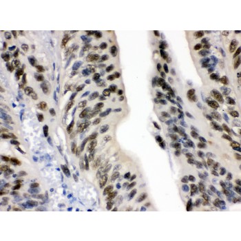 DDB1 Antibody - DDB1 antibody IHC-paraffin. IHC(P): Human Intestinal Cancer Tissue.