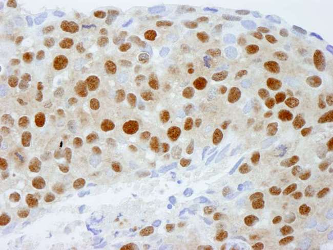 DDB1 Antibody - Detection of Human DDB1 by Immunohistochemistry. Sample: FFPE section of human breast tumor. Antibody: Affinity purified rabbit anti-DDB1 used at a dilution of 1:250.
