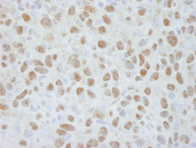 DDB1 Antibody - Detection of Mouse DDB1 by Immunohistochemistry. Sample: FFPE section of mouse squamous cell carcinoma tumor. Antibody: Affinity purified rabbit anti-DDB1 used at a dilution of 1:250.