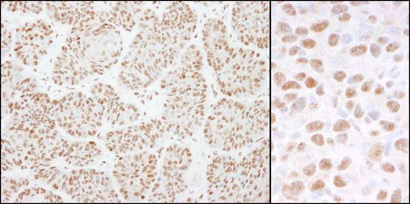 DDB1 Antibody - Detection of Human and Mouse DDB1 by Immunohistochemistry. Sample: FFPE section of human pancreatic islet cell tumor (left) and mouse squamous cell carcinoma (right). Antibody: Affinity purified rabbit anti-DDB1 used at a dilution of 1:1000 (0.2 ug/ml). Detection: DAB.