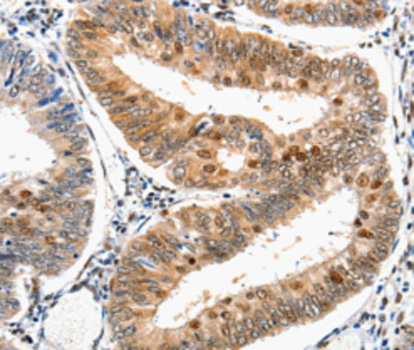 DDB1 Antibody - Immunohistochemistry of paraffin-embedded human cervical cancer tissue.