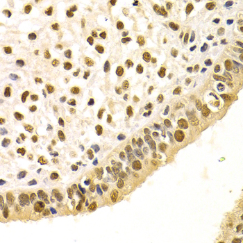 DDB1 Antibody - Immunohistochemistry of paraffin-embedded human metrocarcinoma tissue.