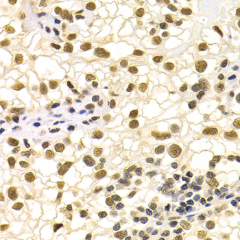 DDB1 Antibody - Immunohistochemistry of paraffin-embedded human kidney cancer tissue.