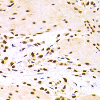 DDB1 Antibody - Immunohistochemistry of paraffin-embedded human stomach cancer tissue.