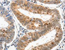 DDB1 Antibody - Immunohistochemistry of paraffin-embedded Human cervical cancer using DDB1 Polyclonal Antibody at dilution of 1:25.