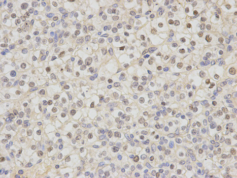 DDB2 Antibody - Immunohistochemistry of paraffin-embedded human kidney cancer using DDB2 antibody at dilution of 1:200 (200x lens).