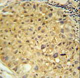 DDC / DOPA Decarboxylase Antibody - DDC Antibody immunohistochemistry of formalin-fixed and paraffin-embedded human hepatocarcinoma followed by peroxidase-conjugated secondary antibody and DAB staining.