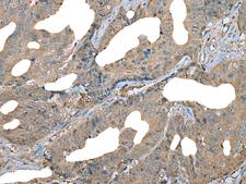 DDC / DOPA Decarboxylase Antibody - Immunohistochemistry of paraffin-embedded Human colorectal cancer tissue  using DDC Polyclonal Antibody at dilution of 1:30(×200)
