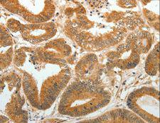 DDH / AKR1C1 Antibody - Immunohistochemistry of paraffin-embedded Human colon cancer using AKR1C1 Polyclonal Antibody at dilution of 1:30.