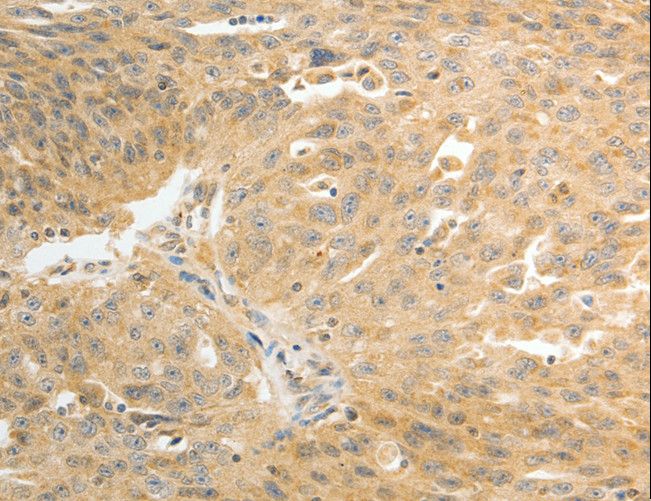 DDH / AKR1C1 Antibody - Immunohistochemistry of paraffin-embedded Human ovarian cancer using AKR1C1 Polyclonal Antibody at dilution of 1:30.