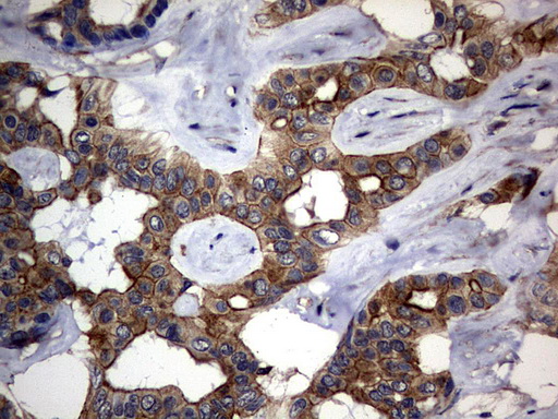 DDIT3 / CHOP Antibody - IHC of paraffin-embedded Carcinoma of Human liver tissue using anti-DDIT3 mouse monoclonal antibody. (Heat-induced epitope retrieval by 1 mM EDTA in 10mM Tris, pH8.5, 120°C for 3min).