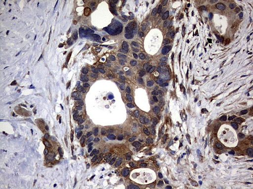 DDIT3 / CHOP Antibody - IHC of paraffin-embedded Carcinoma of Human pancreas tissue using anti-DDIT3 mouse monoclonal antibody. (Heat-induced epitope retrieval by 1 mM EDTA in 10mM Tris, pH8.5, 120°C for 3min).