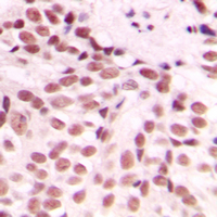 DDIT3 / CHOP Antibody - Immunohistochemical analysis of GADD153 staining in human breast cancer formalin fixed paraffin embedded tissue section. The section was pre-treated using heat mediated antigen retrieval with sodium citrate buffer (pH 6.0). The section was then incubated with the antibody at room temperature and detected using an HRP conjugated compact polymer system. DAB was used as the chromogen. The section was then counterstained with hematoxylin and mounted with DPX.
