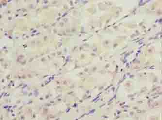 DDIT3 / CHOP Antibody - Immunohistochemistry of paraffin-embedded human gastric cancer using antibody at dilution of 1:100.