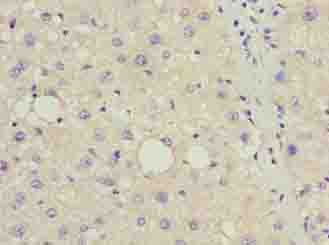 DDIT3 / CHOP Antibody - Immunohistochemistry of paraffin-embedded human liver cancer using antibody at dilution of 1:100.