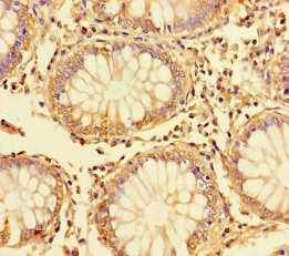DDIT3 / CHOP Antibody - Immunohistochemistry of paraffin-embedded human colon cancer using DDIT3 Antibody at dilution of 1:100