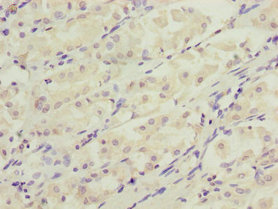 DDIT3 / CHOP Antibody - Immunohistochemistry of paraffin-embedded human gastric cancer using DDIT3 Antibody at dilution of 1:100