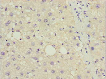 DDIT3 / CHOP Antibody - Immunohistochemistry of paraffin-embedded human liver cancer using DDIT3 Antibody at dilution of 1:100