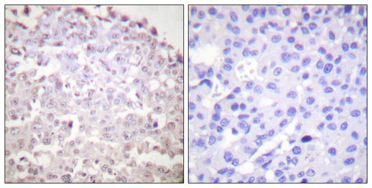 DDIT3 / CHOP Antibody - Peptide - + Immunohistochemical analysis of paraffin-embedded human breast carcinoma tissue using GADD153 antibody.