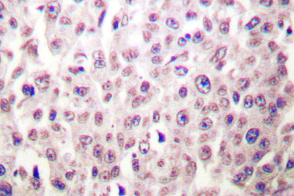 DDIT3 / CHOP Antibody - IHC of GADD153 (K121) pAb in paraffin-embedded human breast carcinoma tissue.